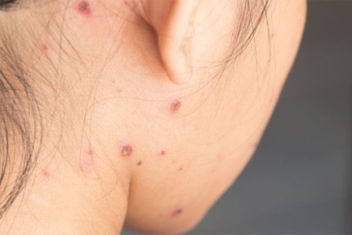 Bị thủy đậu có được gội đầu không