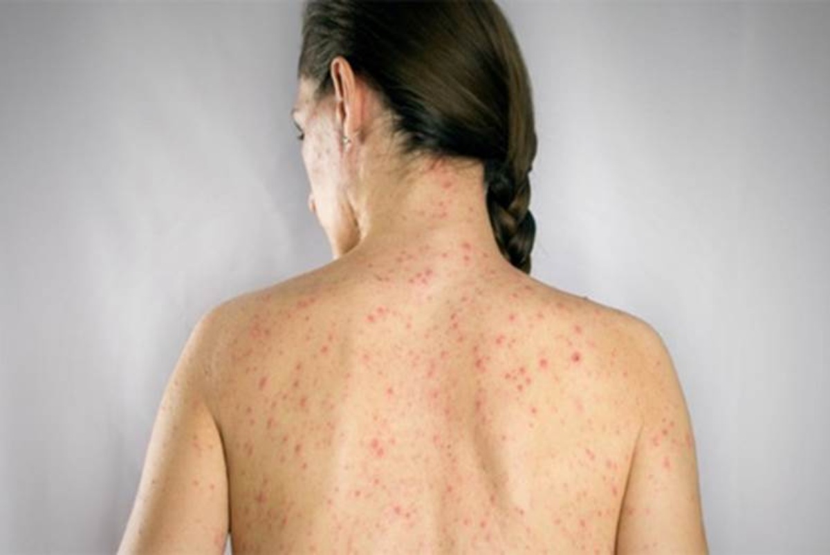 Bị thủy đậu có được gội đầu không