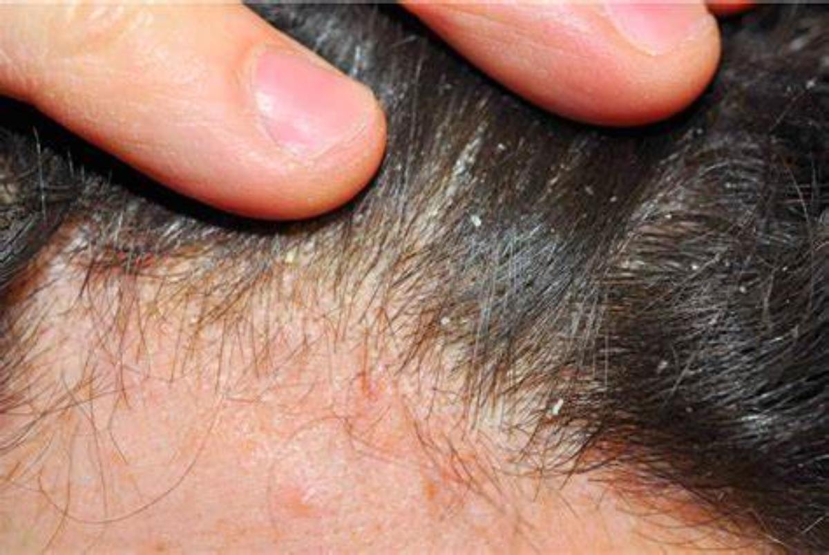 Tại sao gội đầu xong vẫn ngứa